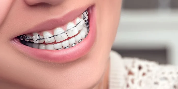 Ceramic-Braces