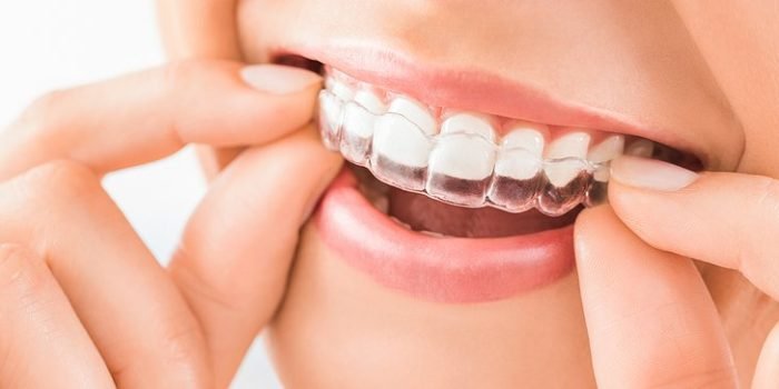 invisalign_OdgNeS7.jpg.874x364_q85_box-0,250,2213,1170_crop_detail