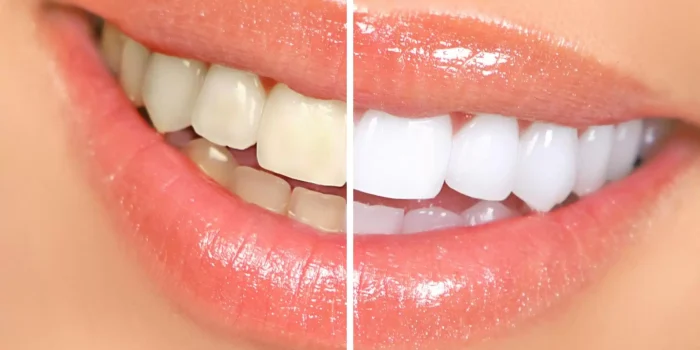 teeth-whitening.jpg